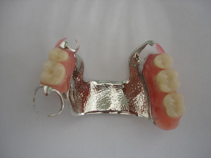 Metal skeleton of a removable partial denture