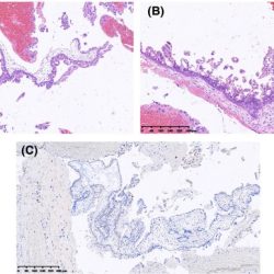 Tubal ligation trompas reversal ligadura falopio invitra steps