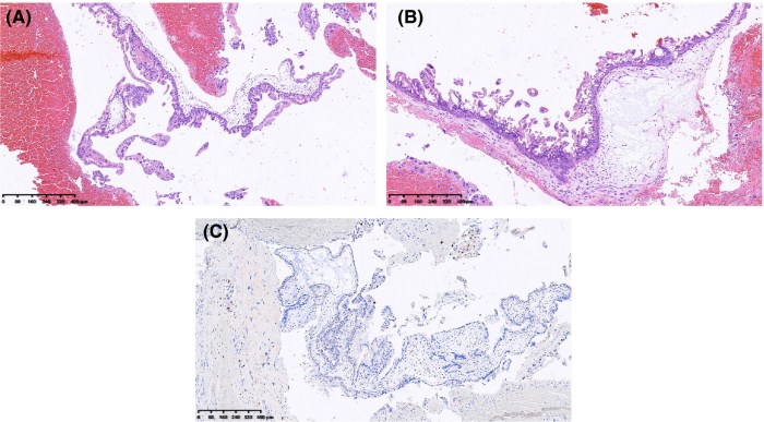 Tubal ligation trompas reversal ligadura falopio invitra steps