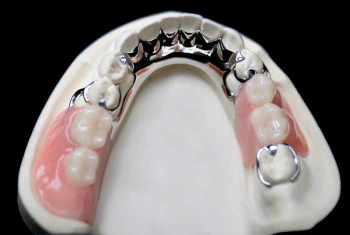 Metal skeleton of a removable partial denture